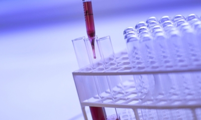 Náhled článku: HPV DNA test pomáhá odhalit riziko rakoviny děložního čípku. Komu ho pojišťovna hradí?